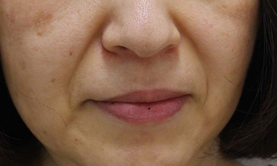 ほうれい線の症例写真（Before）／50代 女性