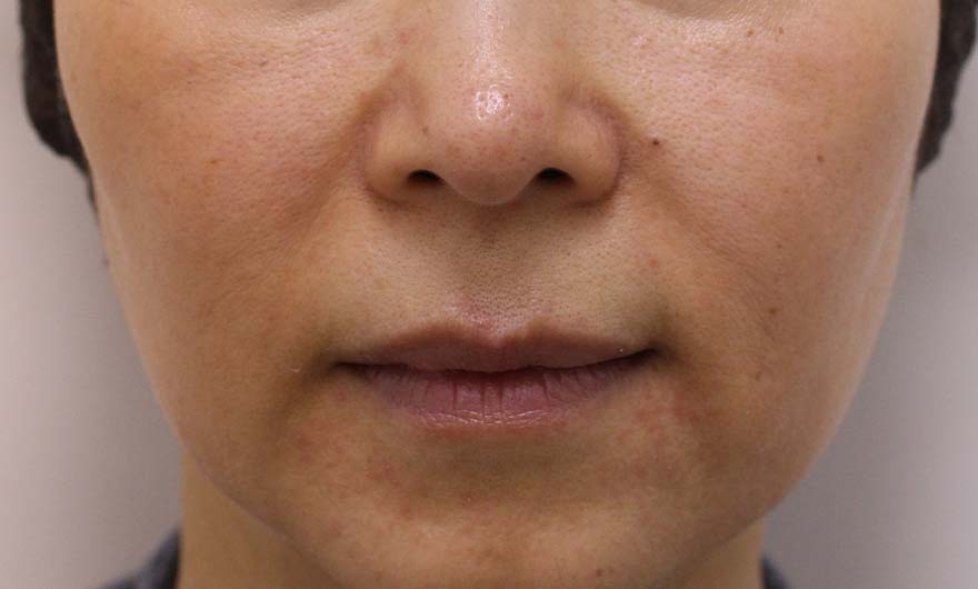 ほうれい線の症例写真（After）／60代 女性