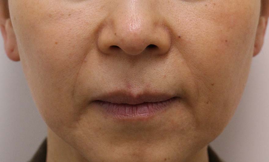 ほうれい線の症例写真（Before）／60代 女性