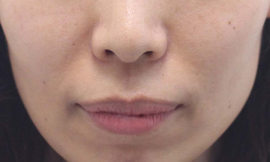 ほうれい線の症例写真（After）／40代 女性