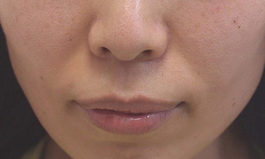 ほうれい線の症例写真（Before）／40代 女性