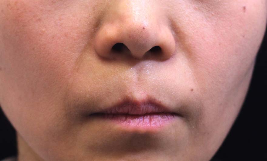 ほうれい線の症例写真（After）／40代 女性