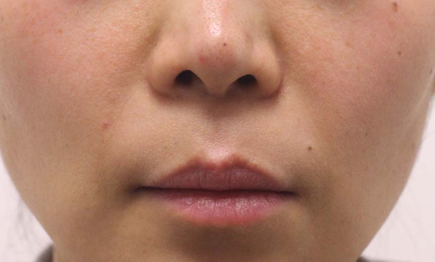 ほうれい線の症例写真（Before）／40代 女性