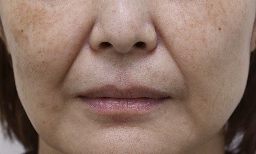 ほうれい線の症例写真（Before）／50代 女性