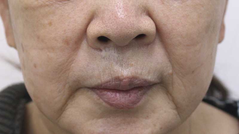 ほうれい線の症例写真（After）／60代 女性