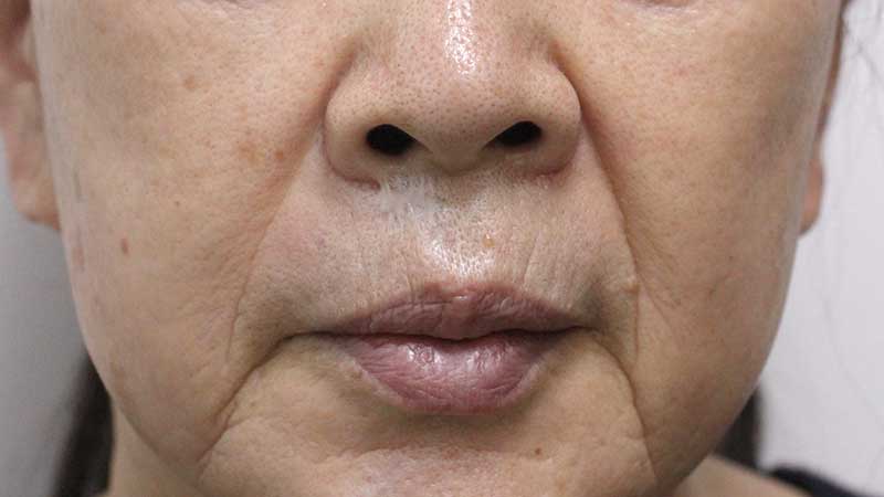ほうれい線の症例写真（Before）／60代 女性