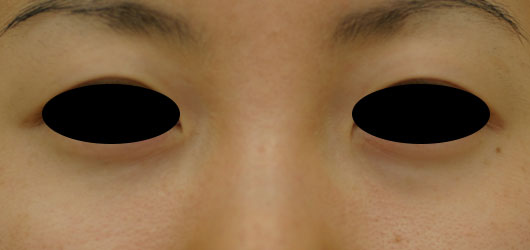 目の下のクマの症例写真（Before）／30代 女性