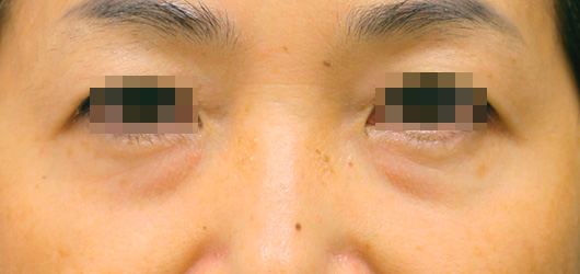 目の下のクマの症例写真（Before）／50代 女性