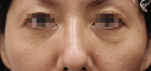 目の下のクマの症例写真（Before）／40代 女性