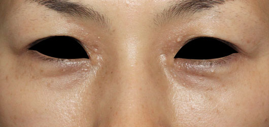 目の下のクマの症例写真（Before）／40代 女性