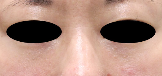 目の下のクマの症例写真（After）／40代 女性