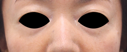目の下のクマの症例写真（After）／40代 女性