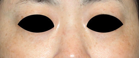 目の下のクマの症例写真（After）／40代 女性