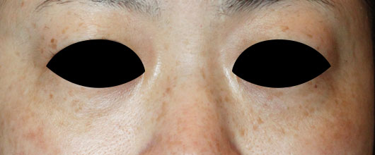 目の下のクマの症例写真（Before）／40代 女性