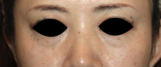 目の下のクマの症例写真（Before）／50代 女性