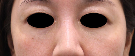 目の下のクマの症例写真（After）／40代 女性