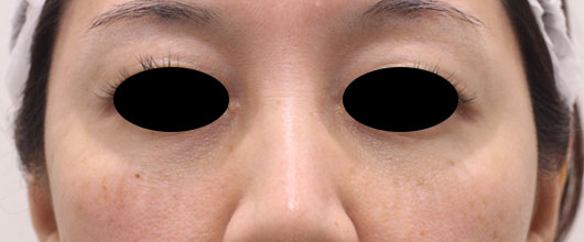 目の下のクマの症例写真（Before）／40代 女性