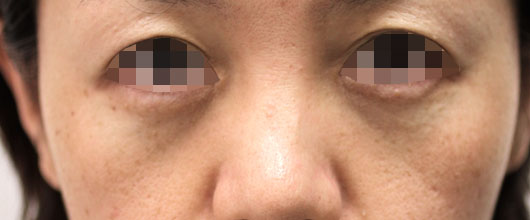 目の下のクマ,ゴルゴ線の症例写真（Before）／40代 女性