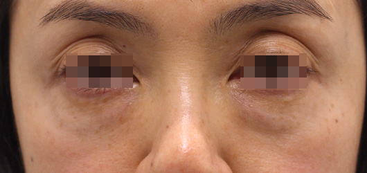 目の下のクマの症例写真（After）／50代 女性