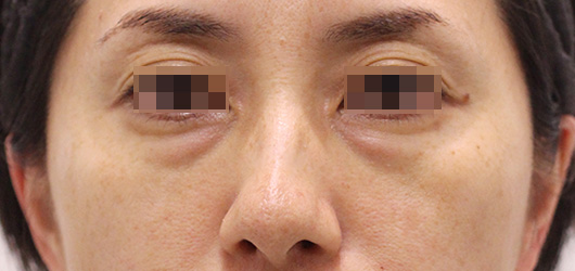 目の下のクマの症例写真（Before）／30代 女性