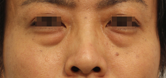 目の下のクマの症例写真（Before）／40代 女性