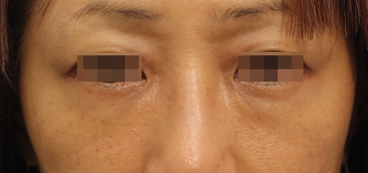 目の下のクマの症例写真（After）／50代 女性