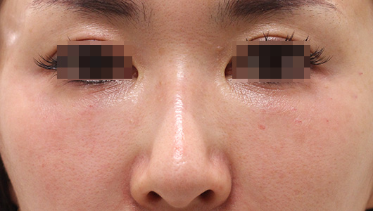 目の下のクマの症例写真（After）／30代 女性
