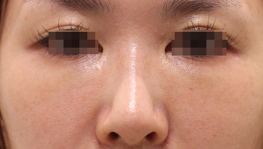 目の下のクマの症例写真（Before）／30代 女性