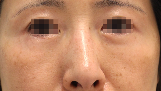 目の下のクマの症例写真（After）／50代 女性