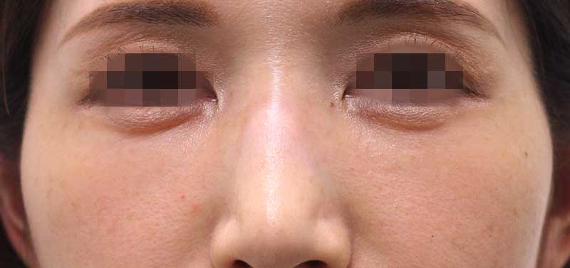 目の下のクマの症例写真（After）／30代 女性