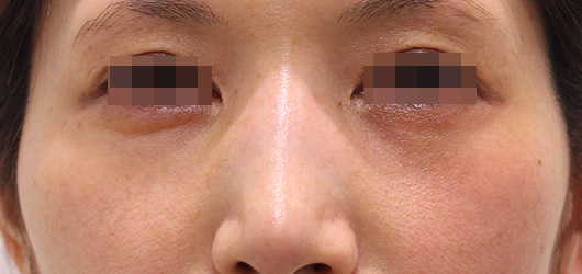 目の下のクマの症例写真（Before）／30代 女性