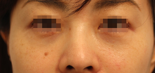 目の下のクマの症例写真（After）／40代 女性