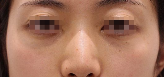 目の下のクマの症例写真（After）／30代 女性
