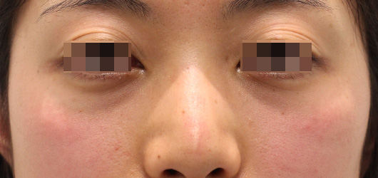 目の下のクマの症例写真（Before）／30代 女性