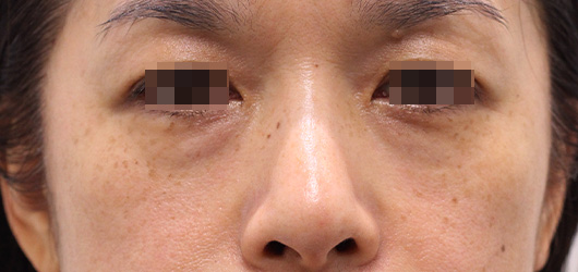 目の下のクマの症例写真（After）／40代 女性