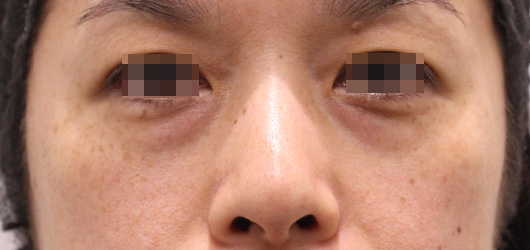 目の下のクマの症例写真（Before）／40代 女性