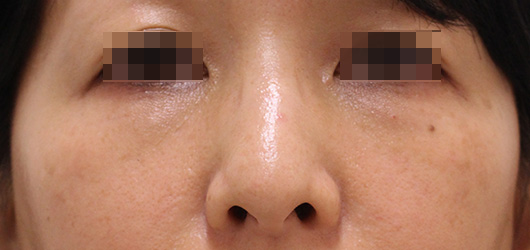 目の下のクマの症例写真（After）／40代 女性