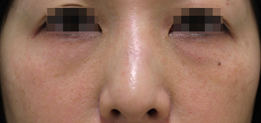 目の下のクマの症例写真（Before）／40代 女性