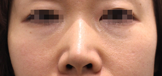 目の下のクマの症例写真（After）／40代 女性