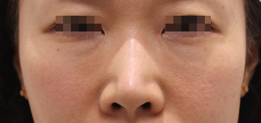目の下のクマの症例写真（Before）／40代 女性