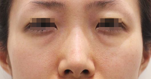 目の下のクマの症例写真（Before）／30代 女性