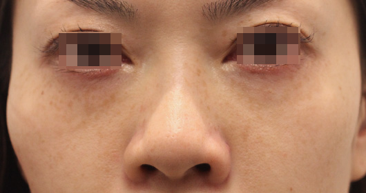 目の下のクマの症例写真（After）／30代 女性