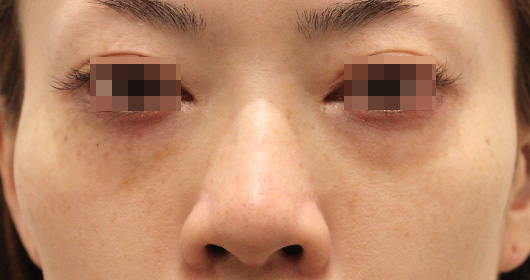 目の下のクマの症例写真（Before）／30代 女性