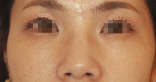 目の下のクマの症例写真（After）／50代 女性