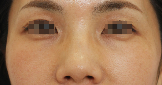 目の下のクマの症例写真（Before）／50代 女性