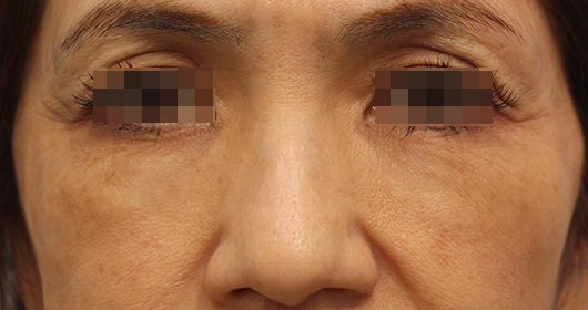 目の下のクマの症例写真（After）／60代 女性