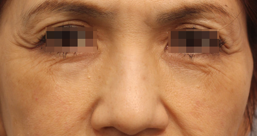 目の下のクマの症例写真（Before）／60代 女性