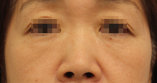 目の下のクマ,ゴルゴ線の症例写真（After）／50代 女性