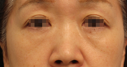 目の下のクマ,ゴルゴ線の症例写真（Before）／50代 女性