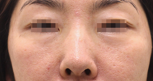 目の下のクマの症例写真（After）／40代 女性